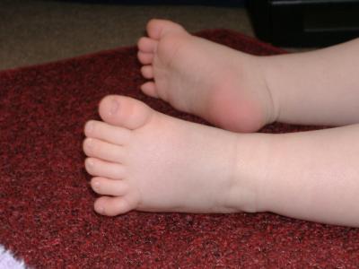 Avery's 6th Toe